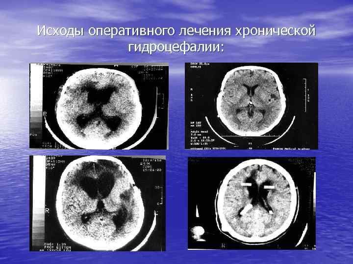 Исходы оперативного лечения хронической гидроцефалии: 