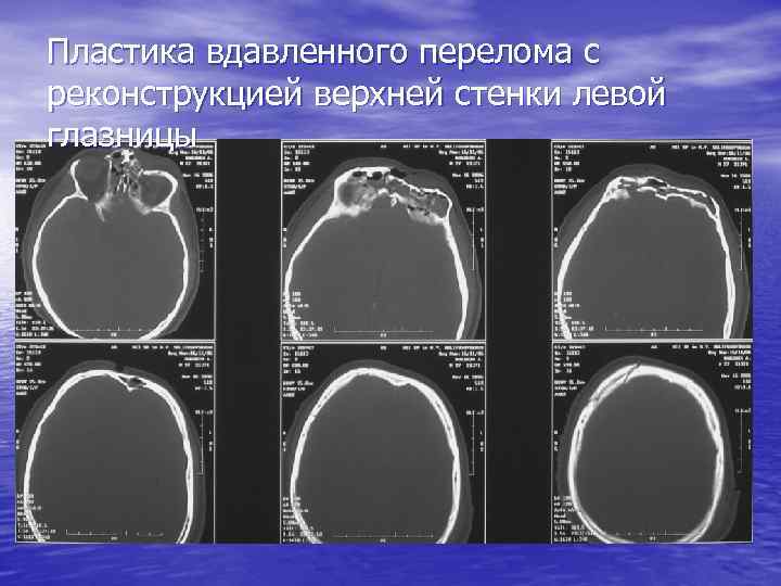 Пластика вдавленного перелома с реконструкцией верхней стенки левой глазницы 