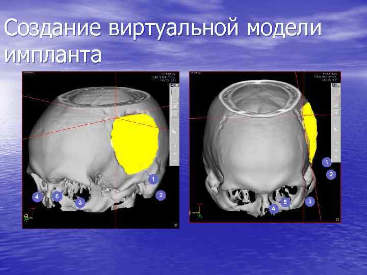 Создание виртуальной модели импланта 