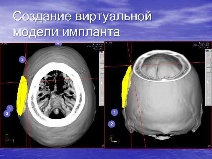 Создание виртуальной модели импланта 