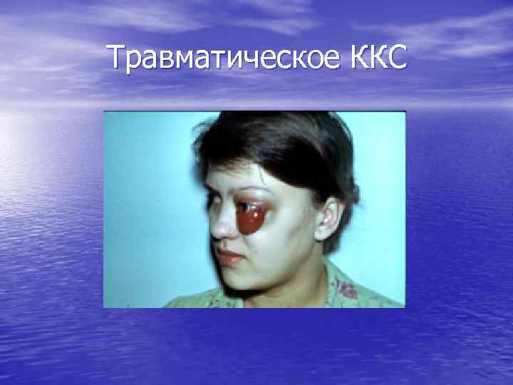 Травматическое ККС 