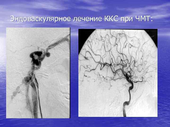 Эндоваскулярное лечение ККС при ЧМТ: 