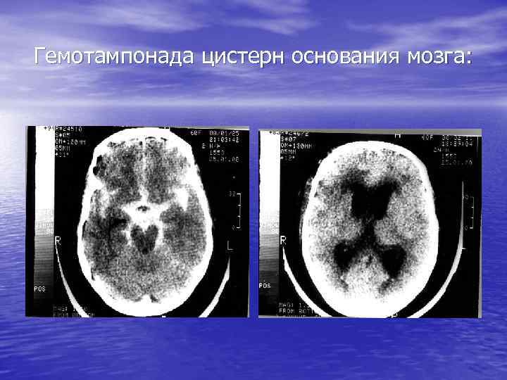 Гемотампонада цистерн основания мозга: 