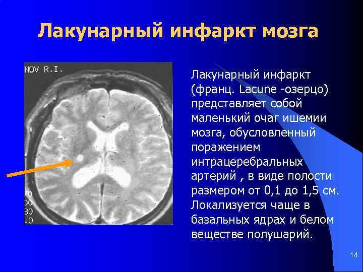 Лакунарный инфаркт мозга Лакунарный инфаркт (франц. Lacune -озерцо) представляет собой маленький очаг ишемии мозга,