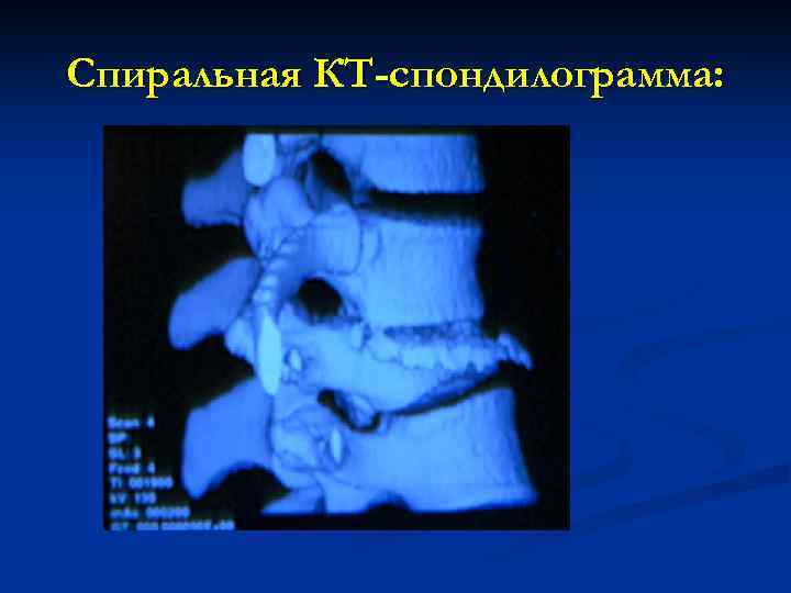 Спиральная КТ-спондилограмма: 