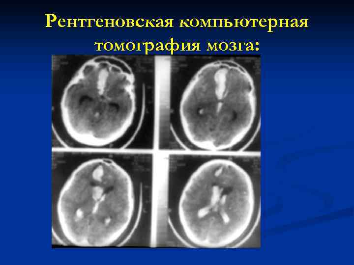 Рентгеновская компьютерная томография мозга: 