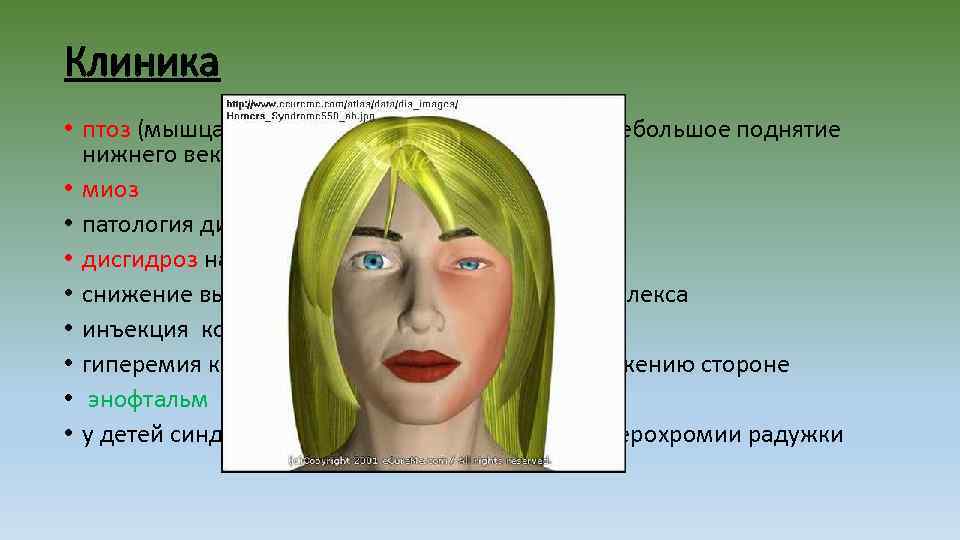 Клиника • птоз (мышца. Мюллера), «перевернутый птоз» (небольшое поднятие нижнего века) • миоз •