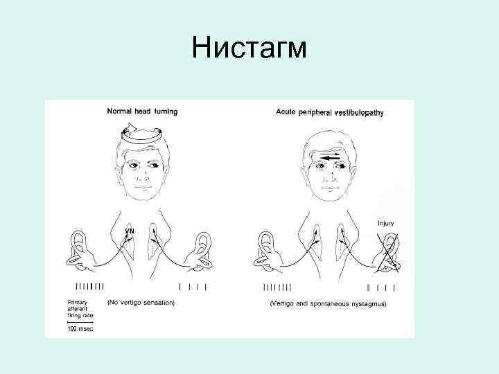 Нистагм 