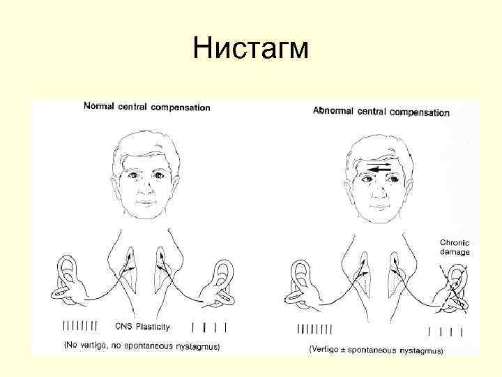 Нистагм 