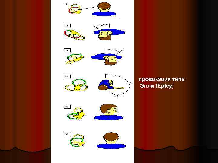 провокация типа Эпли (Epley) 