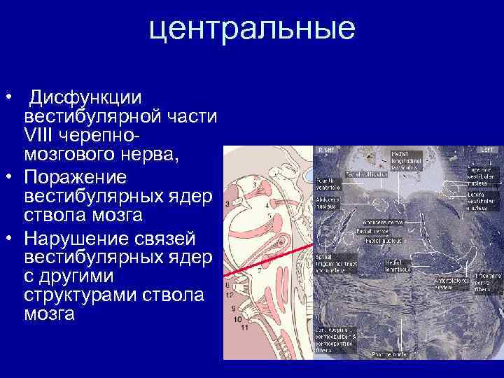 центральные • Дисфункции вестибулярной части VIII черепномозгового нерва, • Поражение вестибулярных ядер ствола мозга