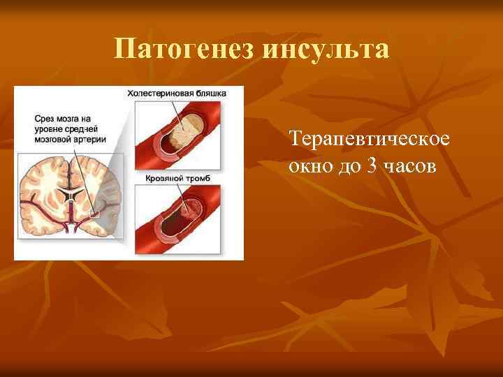Патогенез инсульта Терапевтическое окно до 3 часов 
