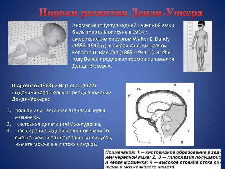 Пороки развития Денди-Уокера Аномалия структур задней черепной ямки была впервые описана в 1914 г.