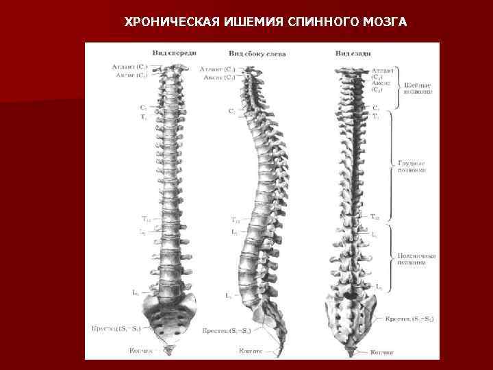 ХРОНИЧЕСКАЯ ИШЕМИЯ СПИННОГО МОЗГА 