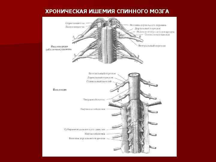 ХРОНИЧЕСКАЯ ИШЕМИЯ СПИННОГО МОЗГА 