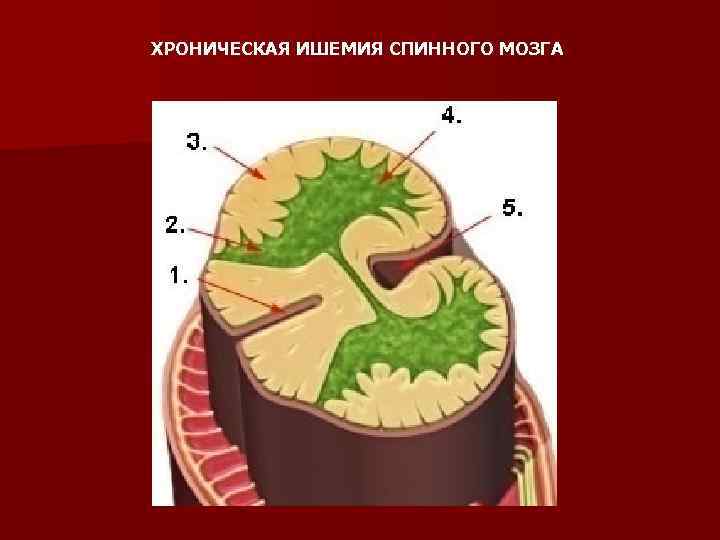 ХРОНИЧЕСКАЯ ИШЕМИЯ СПИННОГО МОЗГА 