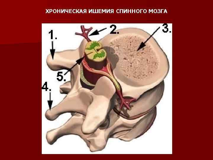 ХРОНИЧЕСКАЯ ИШЕМИЯ СПИННОГО МОЗГА 