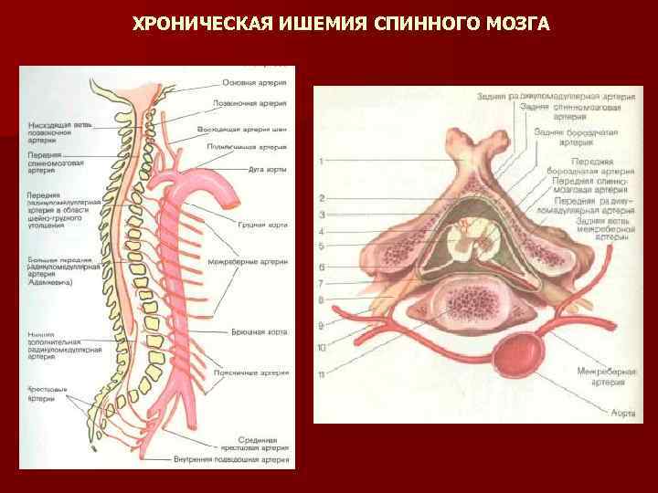 ХРОНИЧЕСКАЯ ИШЕМИЯ СПИННОГО МОЗГА 