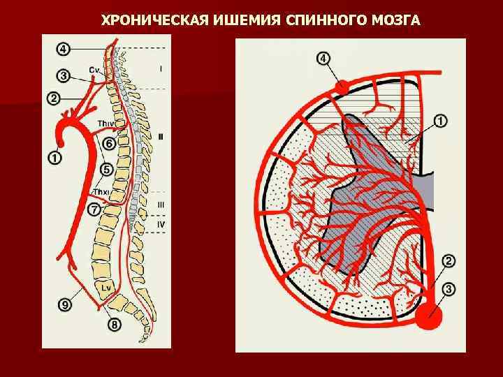 ХРОНИЧЕСКАЯ ИШЕМИЯ СПИННОГО МОЗГА 