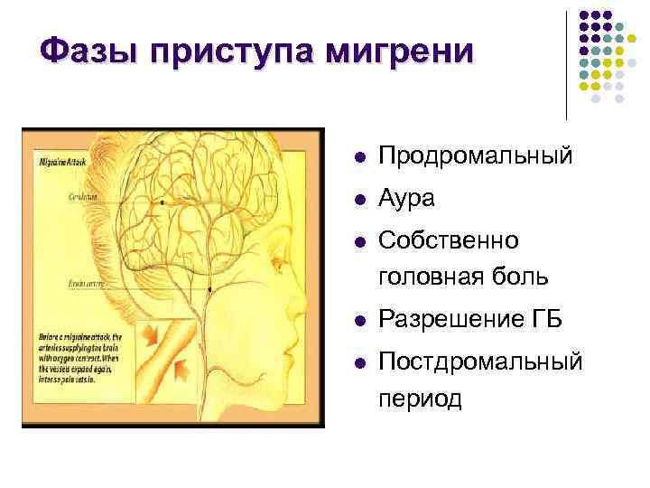 Фазы приступа мигрени l Продромальный l Аура l Собственно головная боль l Разрешение ГБ