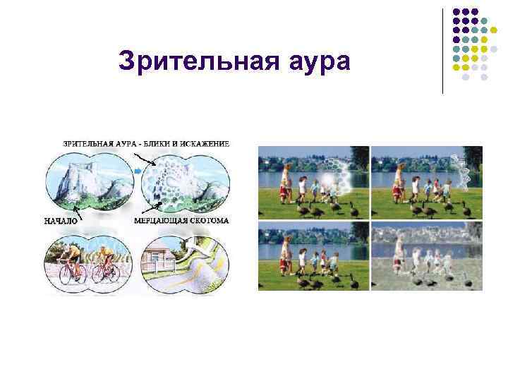 Зрительная аура 