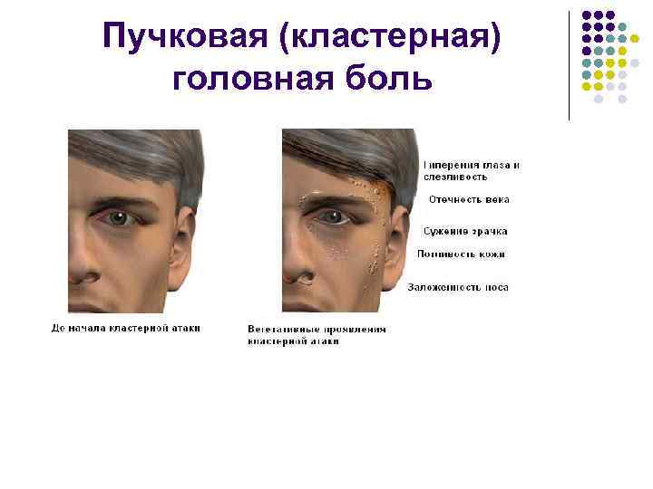 Пучковая (кластерная) головная боль 