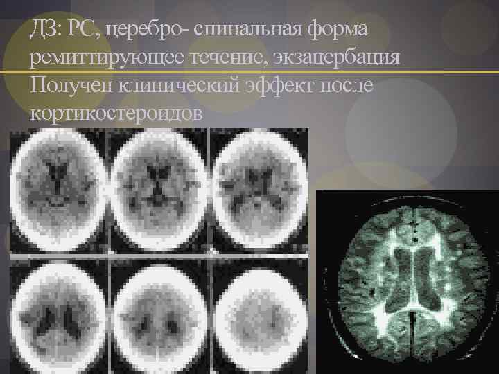 ДЗ: РС, церебро- спинальная форма ремиттирующее течение, экзацербация Получен клинический эффект после кортикостероидов 