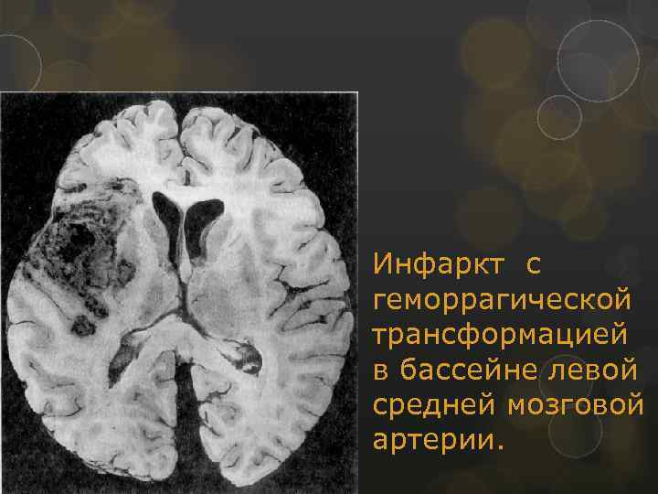 Инфаркт с геморрагической трансформацией в бассейне левой средней мозговой артерии. 