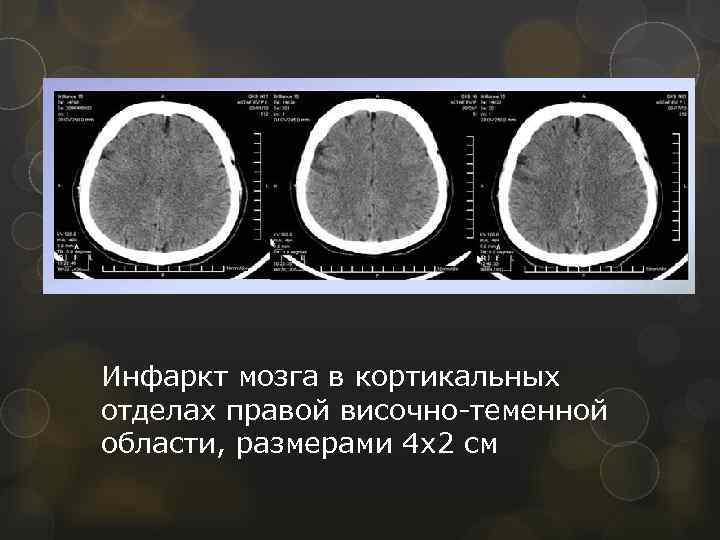 Инфаркт мозга в кортикальных отделах правой височно-теменной области, размерами 4 х2 см 