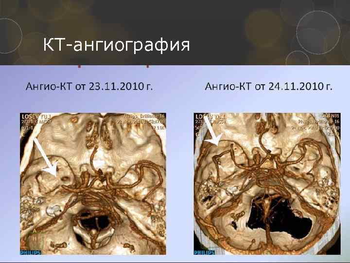 КТ-ангиография 