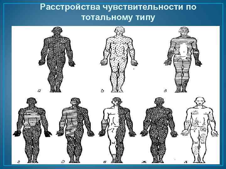 Расстройства чувствительности по тотальному типу 