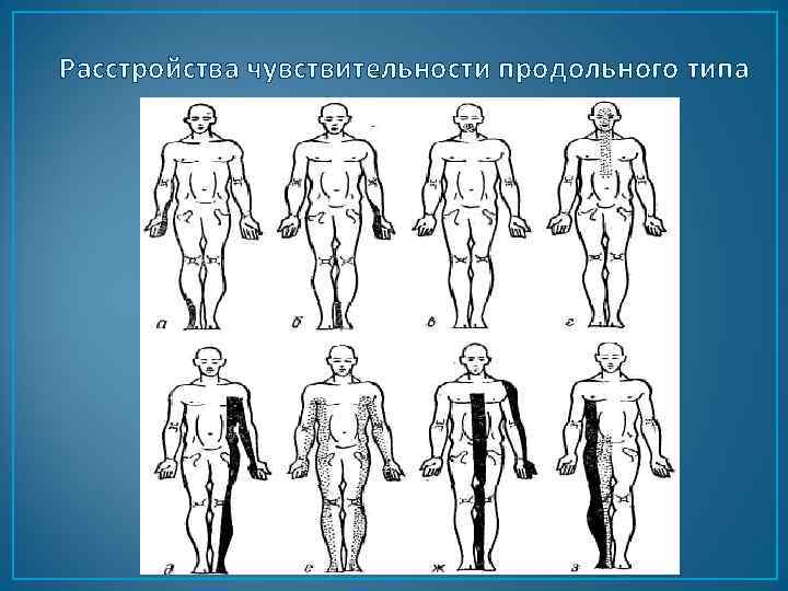 Расстройства чувствительности продольного типа 