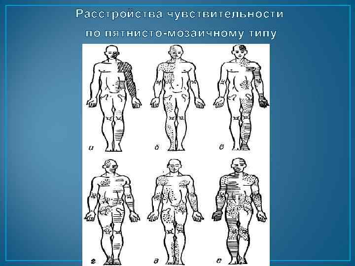 Расстройства чувствительности по пятнисто-мозаичному типу 