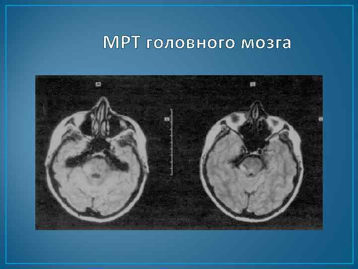 МРТ головного мозга 