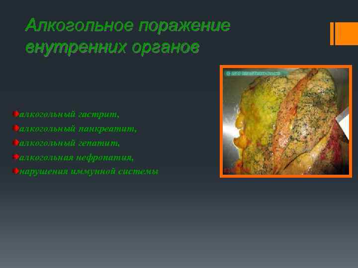 Алкогольное поражение внутренних органов алкогольный гастрит, алкогольный панкреатит, алкогольный гепатит, алкогольная нефропатия, нарушения иммунной