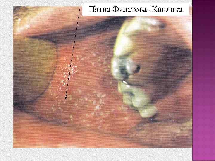 Пятна Филатова -Коплика 
