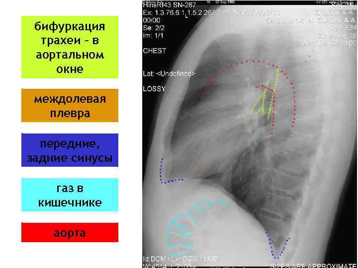 бифуркация трахеи – в аортальном окне междолевая плевра передние, задние синусы газ в кишечнике