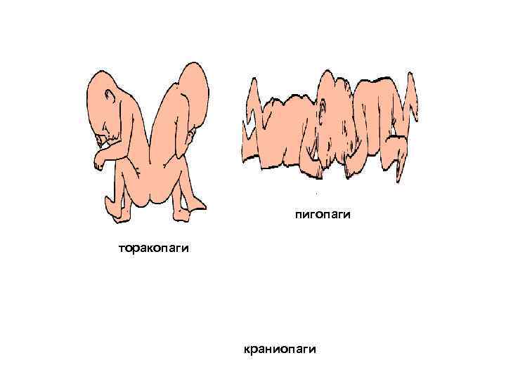 пигопаги торакопаги краниопаги 