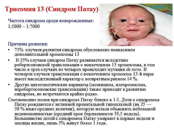 Трисомия 13 (Синдром Патау) Частота синдрома среди новорожденных: 1: 5000 – 1: 7000 Причины