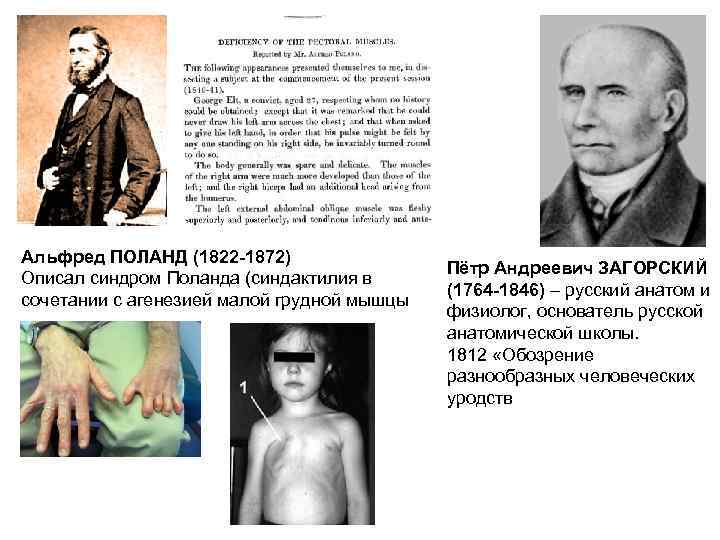 Альфред ПОЛАНД (1822 -1872) Описал синдром Поланда (синдактилия в сочетании с агенезией малой грудной