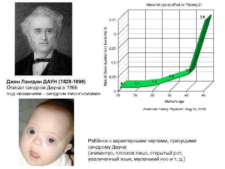 Джон Лангдон ДАУН (1828 -1896) Описал синдром Дауна в 1866 под названием - синдром