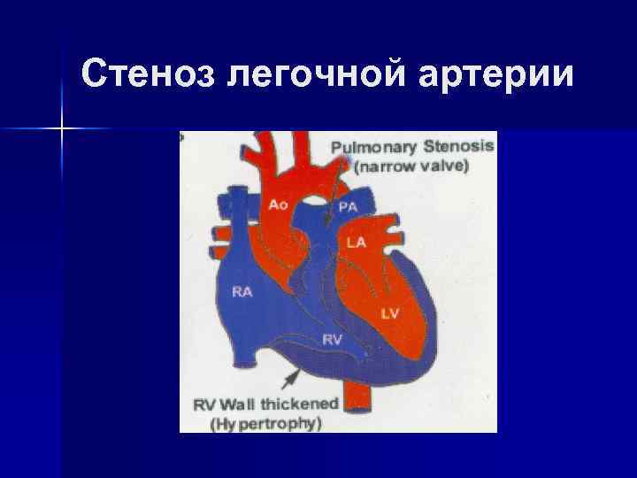 Стеноз легочной артерии 