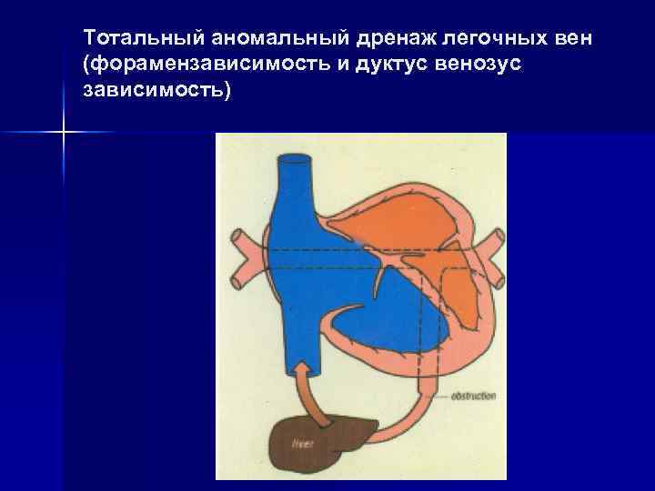 Тотальный аномальный дренаж легочных вен (форамензависимость и дуктус венозус зависимость) 