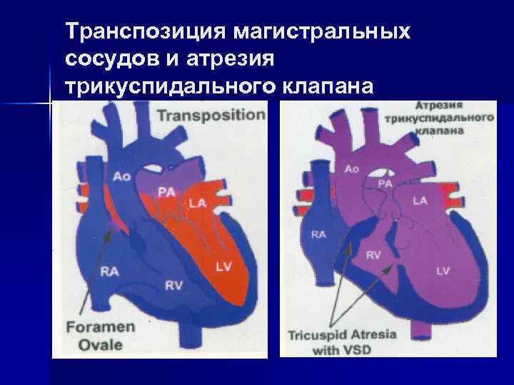 Транспозиция артерий