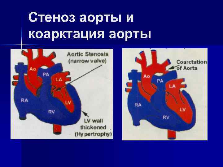 Стеноз аорты и коарктация аорты 