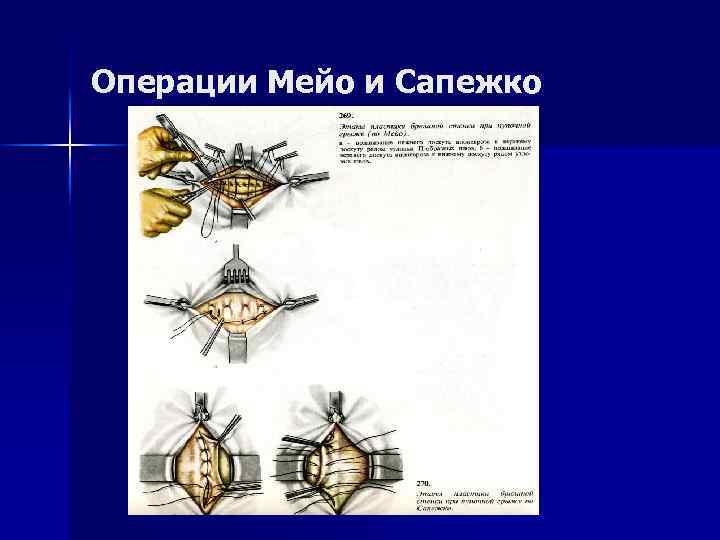 Пластика грыж по сапежко