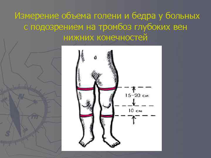 Измерение объема голени и бедра у больных с подозрением на тромбоз глубоких вен нижних
