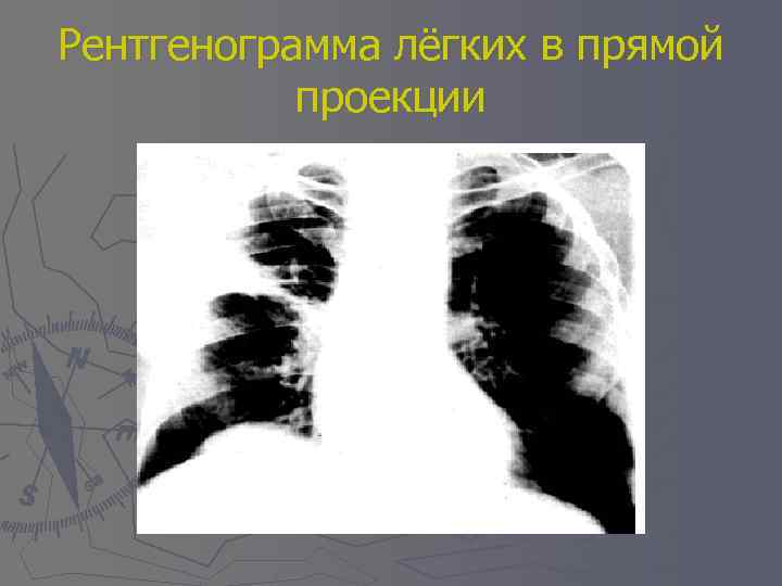 Рентгенограмма лёгких в прямой проекции 