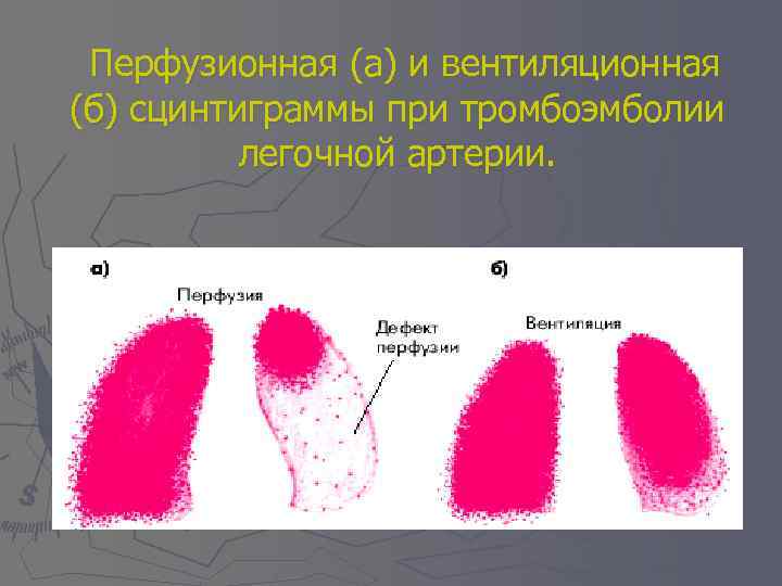 Перфузионная (а) и вентиляционная (б) сцинтиграммы при тромбоэмболии легочной артерии. 