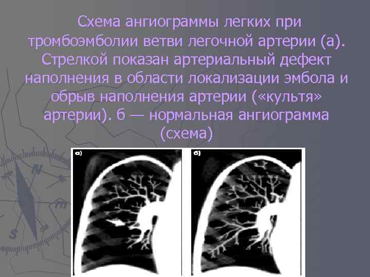 Тромбоэмболия мелких ветвей легочной артерии. Тэла мелких ветвей легочной артерии кт. Тромбоз лёгочной артерии симптомы. Рентгенологический синдром тромбоэмболии легочной артерии. Кт признаки Тэла мелких ветвей легочной артерии.